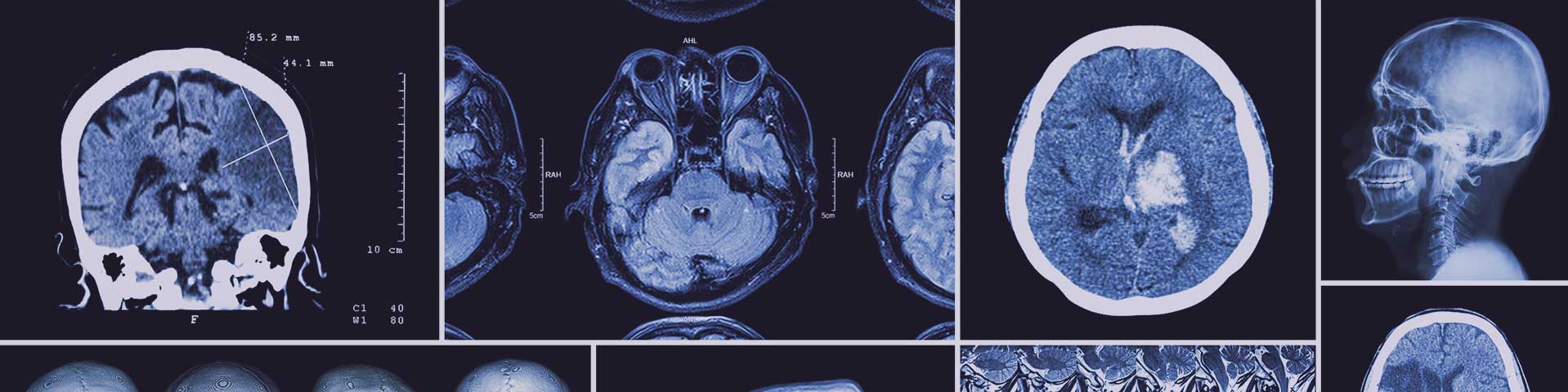 xrays of catastrophic brain injuries